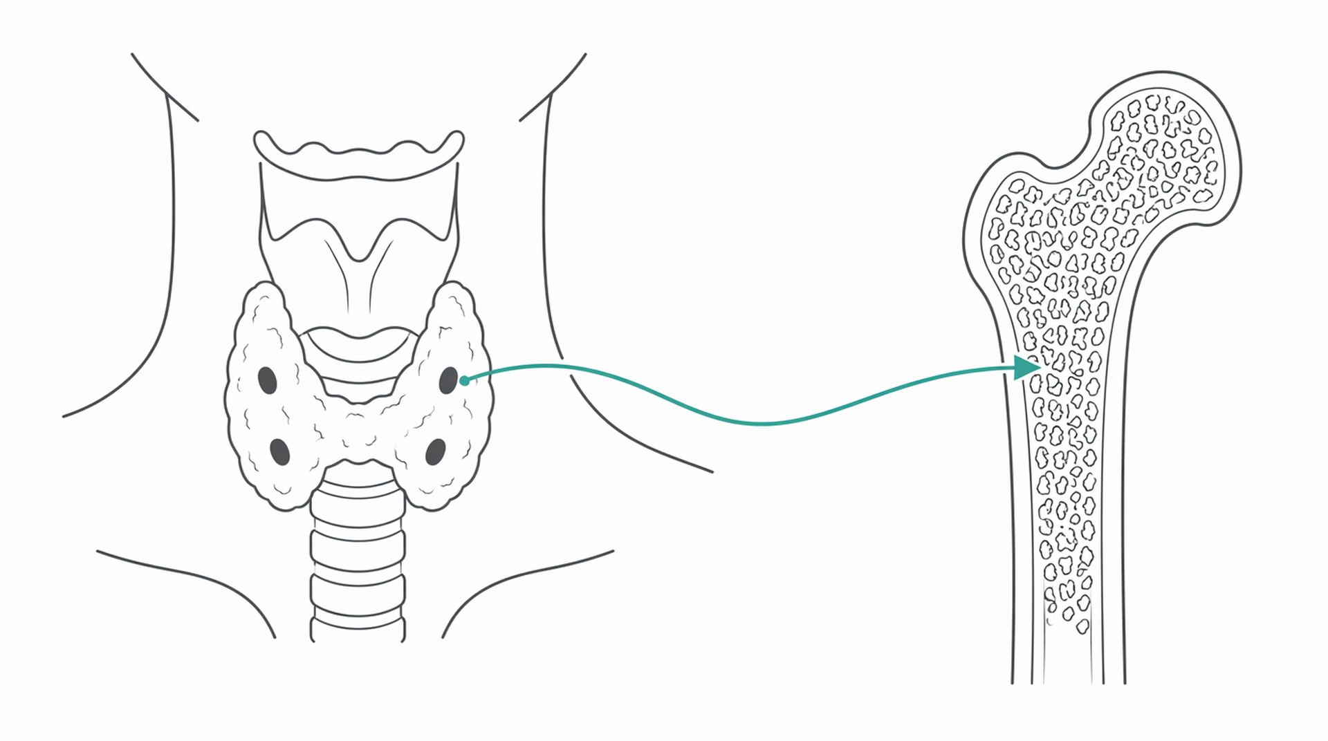 Medical line illustration of parathyroid calcium bone for Parathyroid surgery.