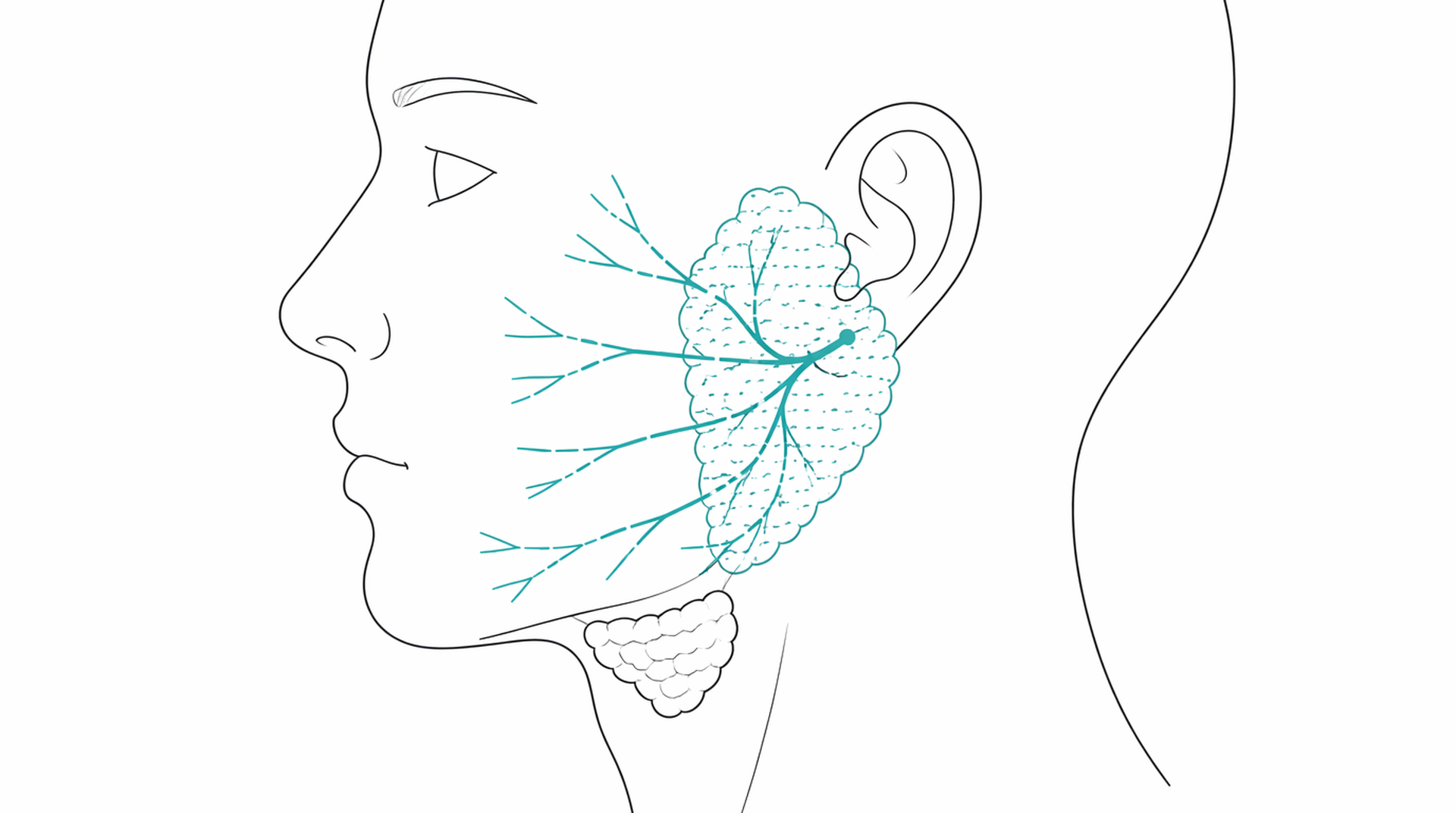 Medical line illustration of parotid salivary gland surgery for Neck lump removal.
