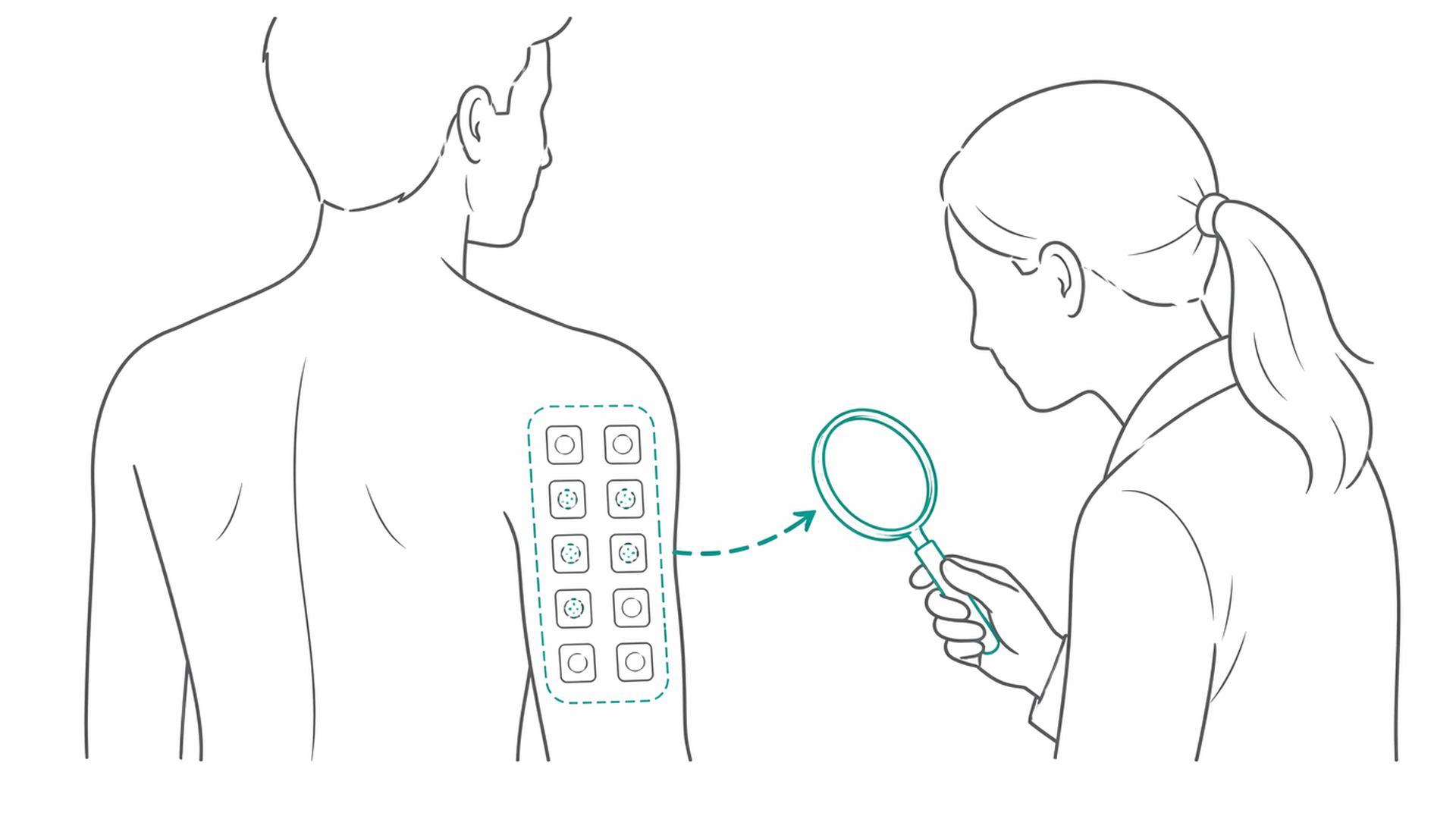 Medical line illustration of patch testing contact dermatitis for Patch testing for allergic contact dermatitis.