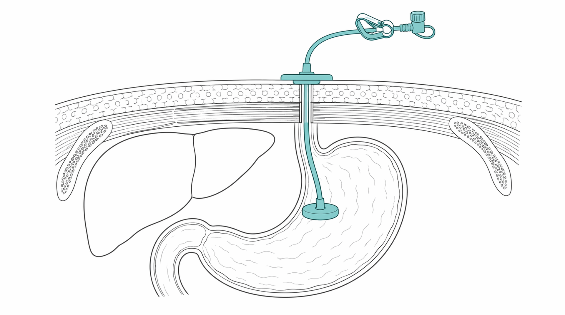 Medical line illustration of peg feeding tube for PEG feeding tube insertion.