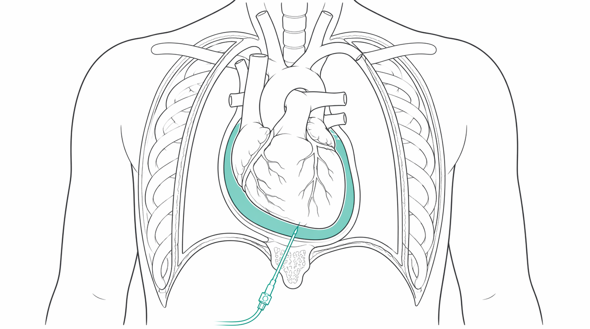 Medical line illustration of pericardial effusion drainage for Pericardial window / drainage.