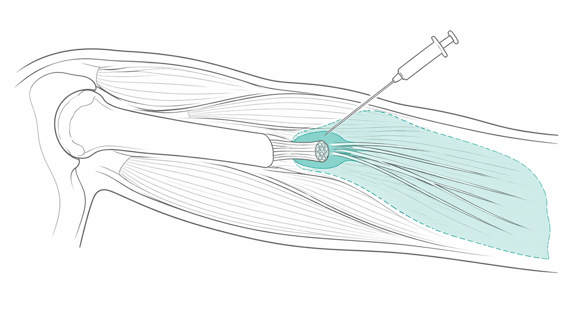 Medical line illustration of peripheral nerve block limb for Peripheral nerve block.
