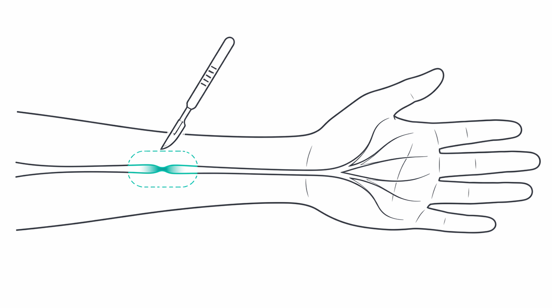 Medical line illustration of peripheral nerve surgery for Peripheral nerve surgery.