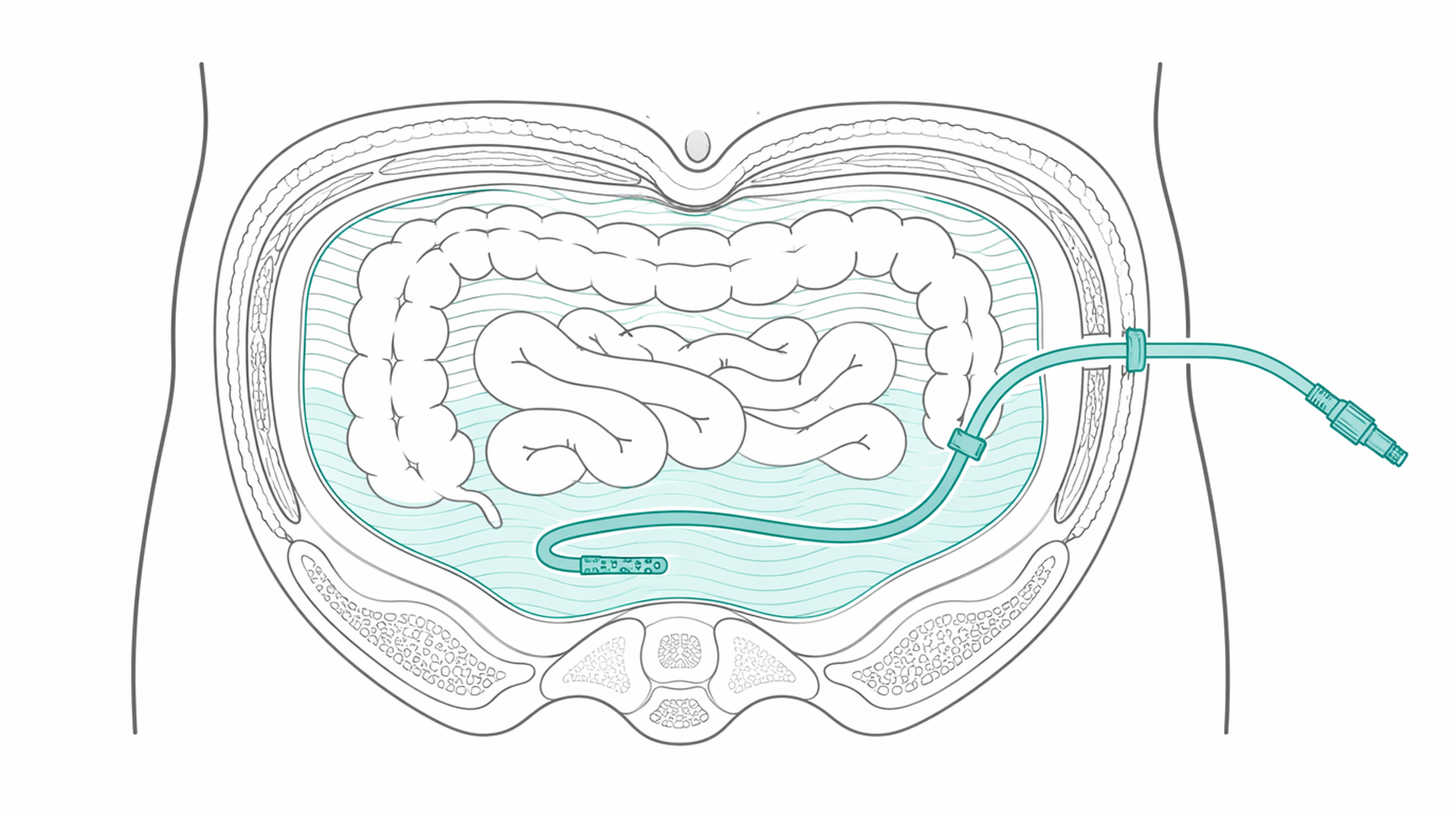 Medical line illustration of peritoneal dialysis catheter abdomen for Dialysis access (fistula) assessment.