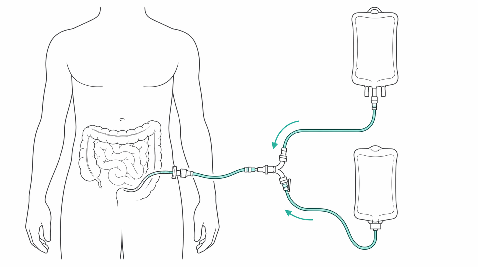 Medical line illustration of peritoneal dialysis for Peritoneal dialysis.