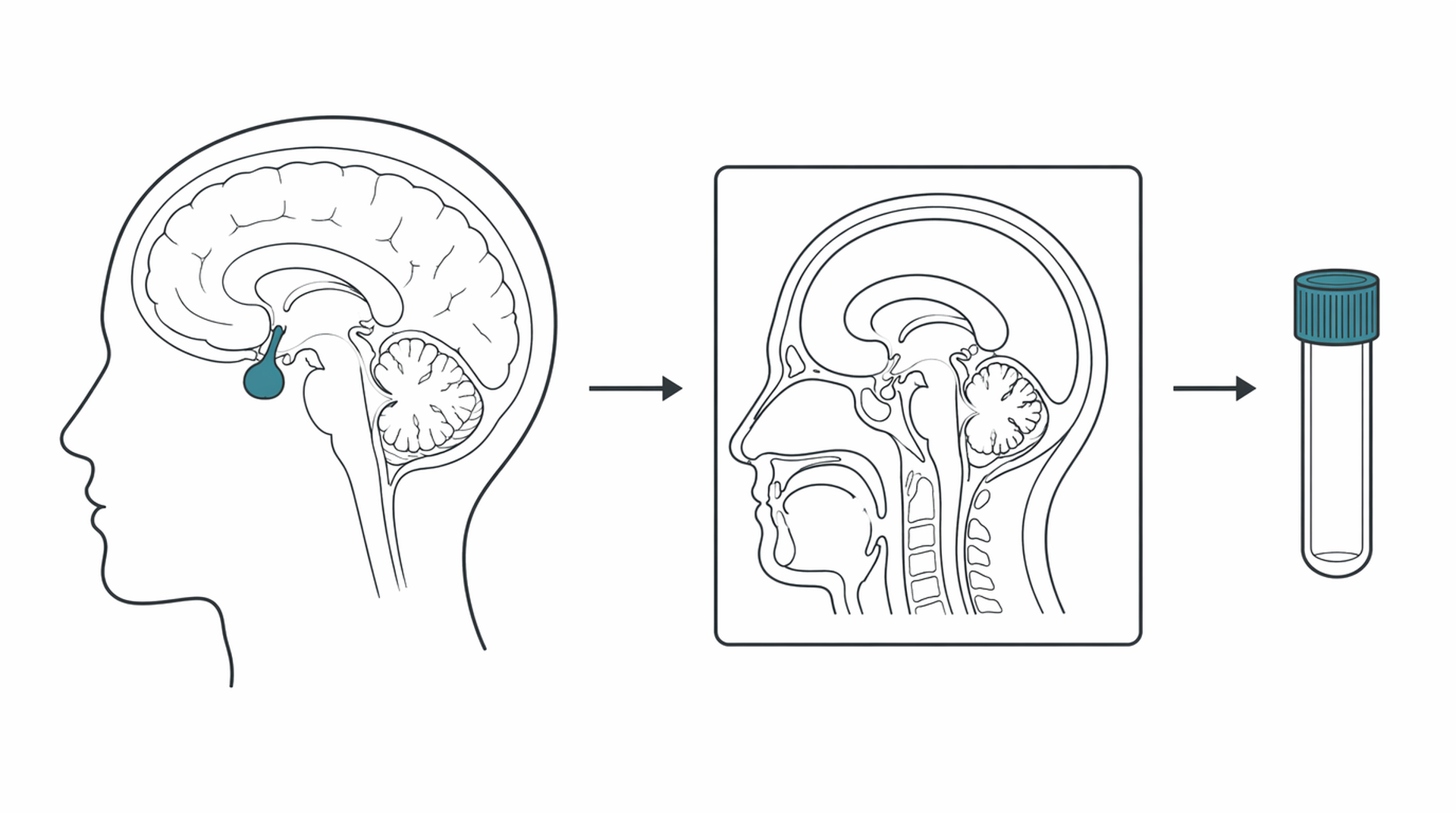Medical line illustration of pituitary mri hormone testing for Acromegaly treatment.