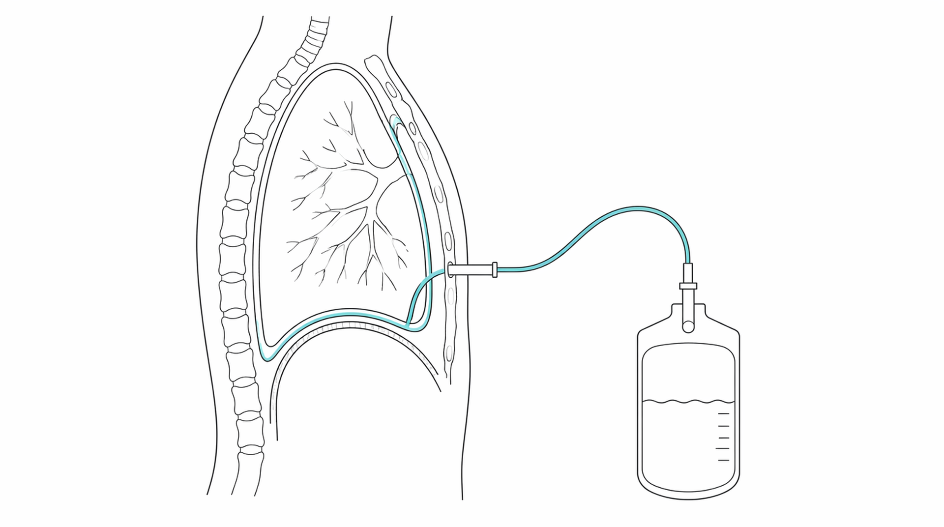 Medical line illustration of pleural aspiration chest drain for Pleural aspiration (chest drain).
