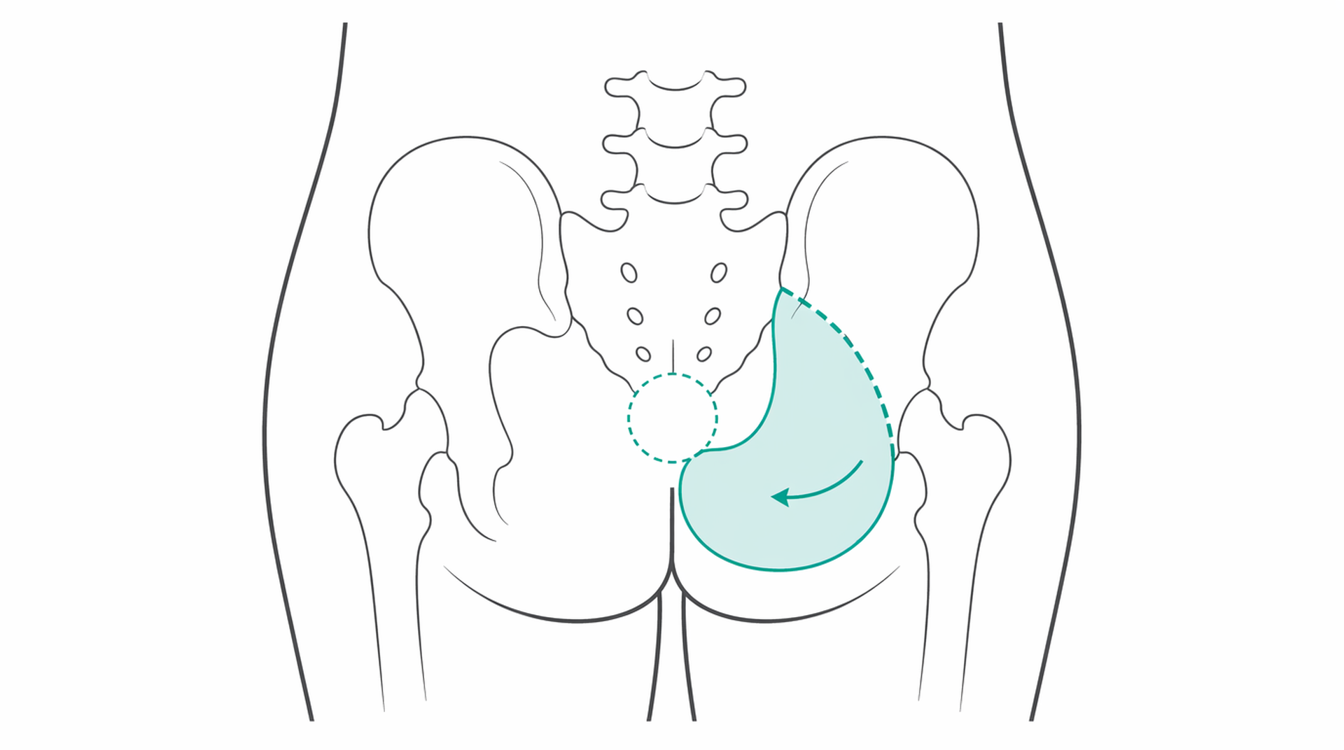 Medical line illustration of pressure sore reconstruction for Pressure sore reconstruction.