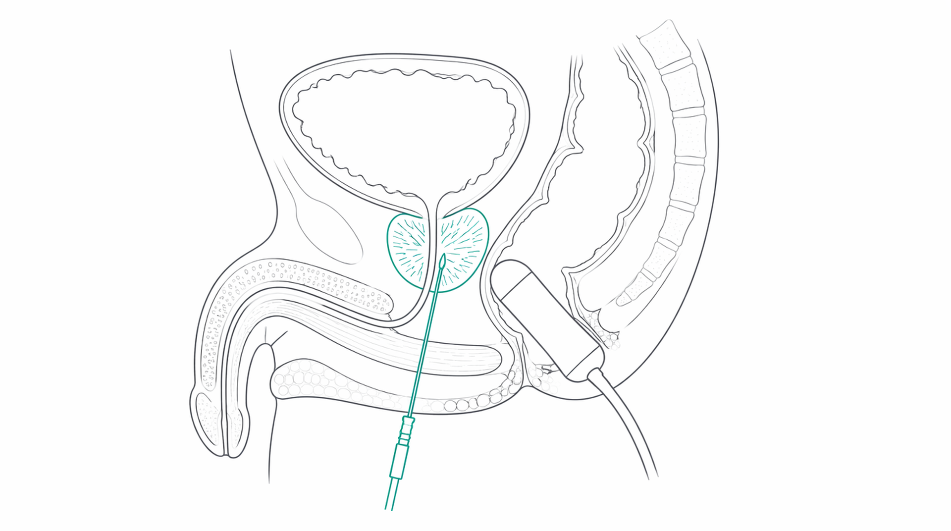Medical line illustration of prostate biopsy needle pathway for Prostate biopsy.