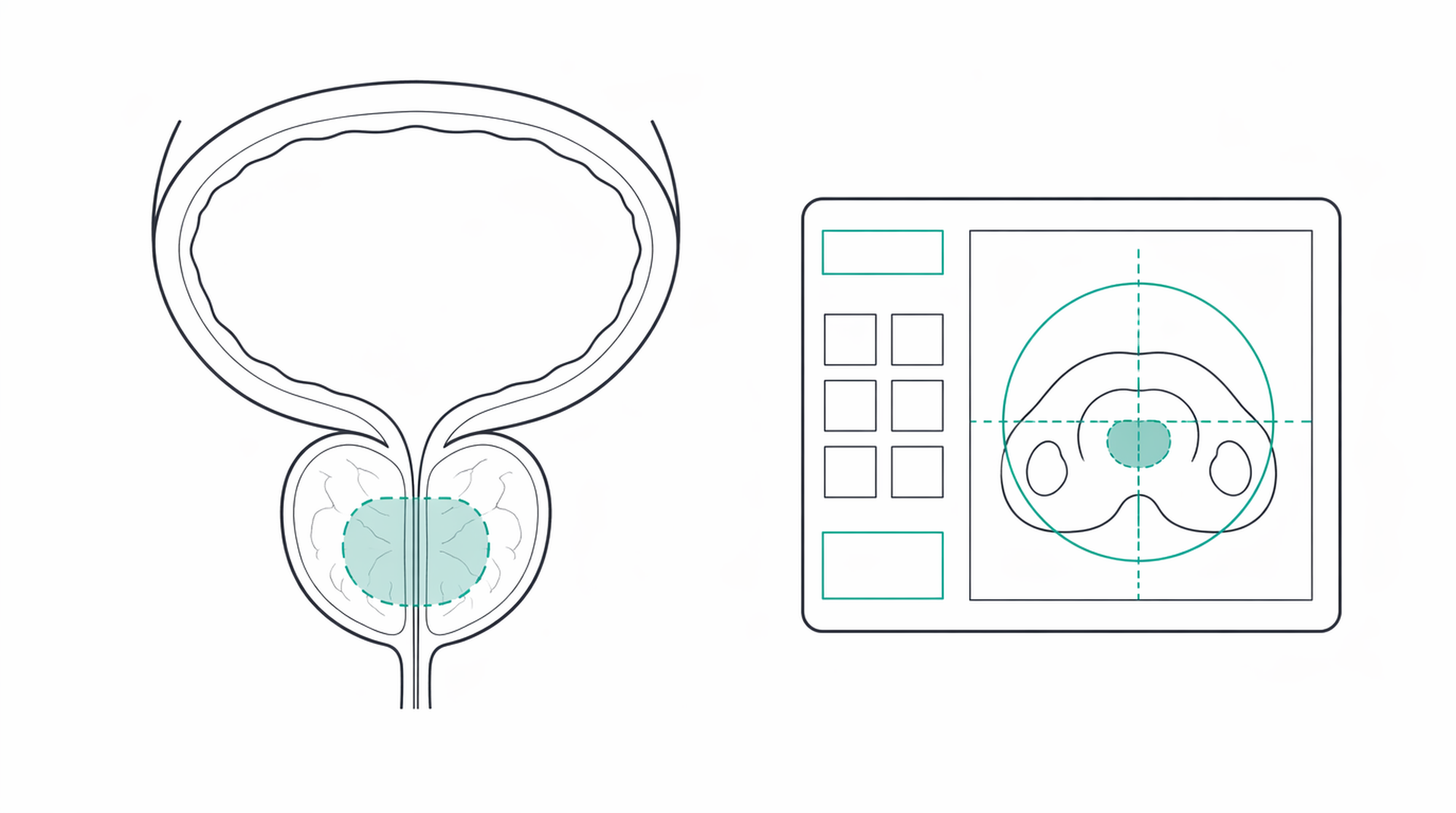 Medical line illustration of prostate cancer treatment for Prostate cancer radiotherapy.