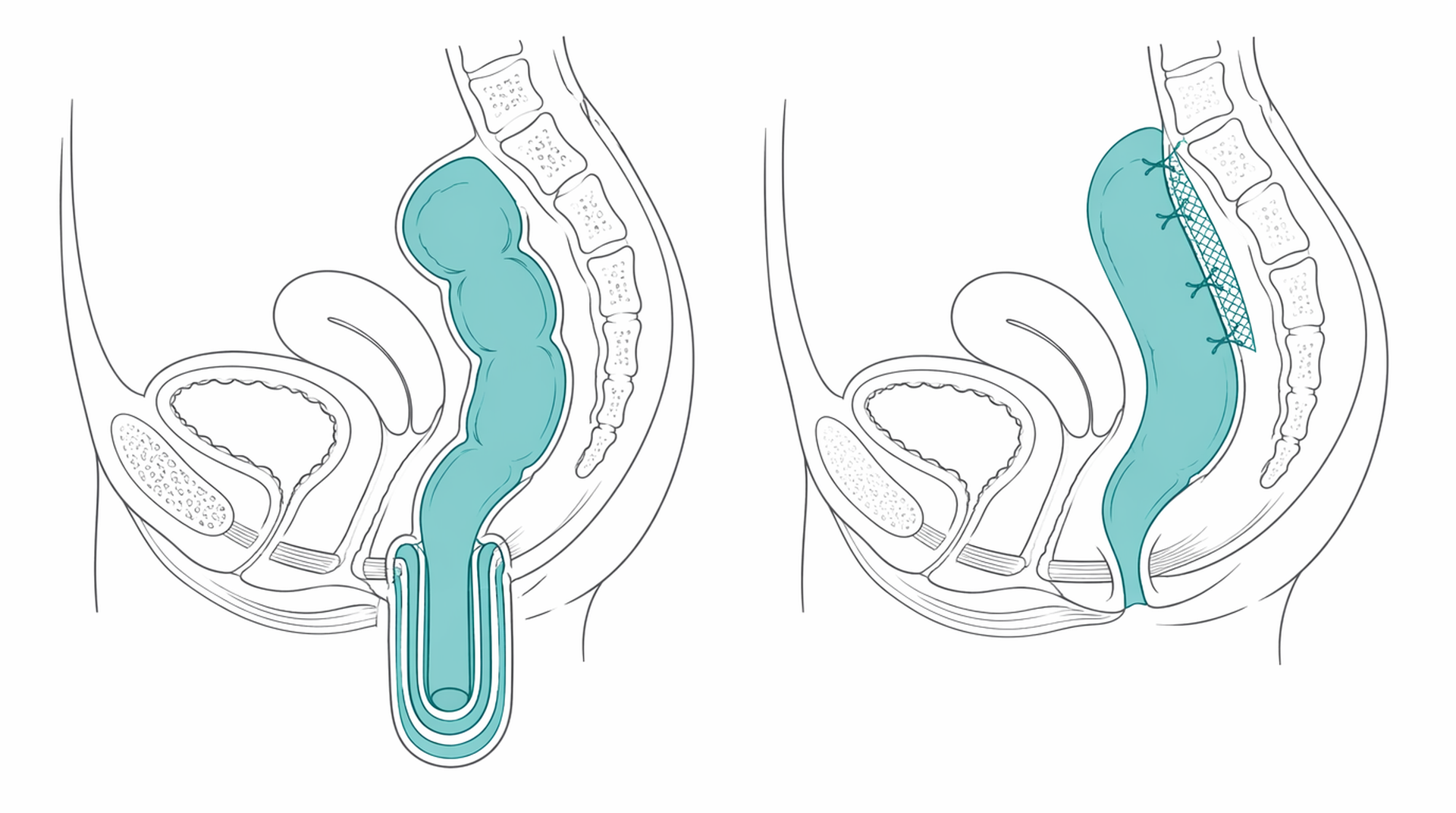 Medical line illustration of rectal prolapse repair for Rectal prolapse repair (rectopexy).