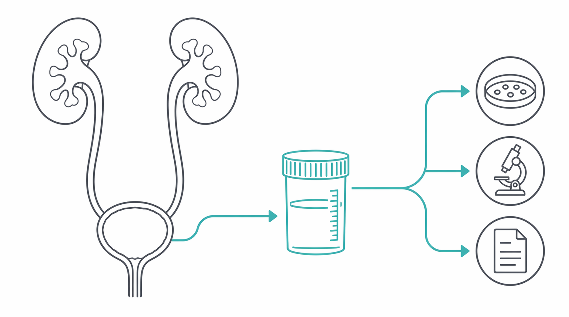 Medical line illustration of recurrent uti assessment for Recurrent urinary tract infection assessment.