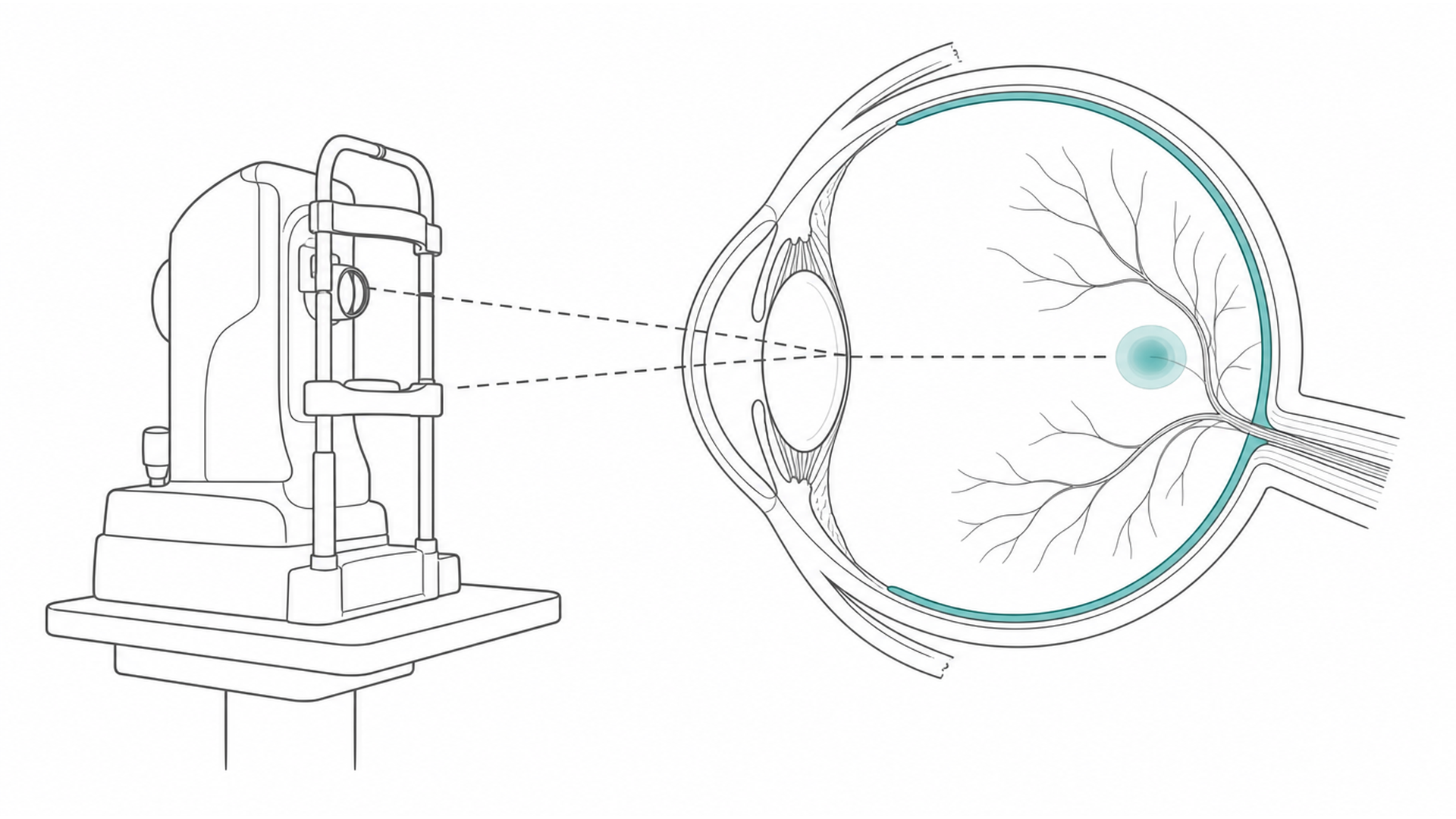 Medical line illustration of retina imaging and treatment planning for Retinal detachment surgery.