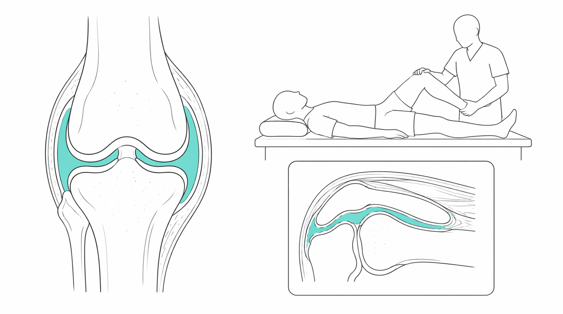 Medical line illustration of rheumatology joint inflammatory disease for Psoriatic arthritis treatment and management.