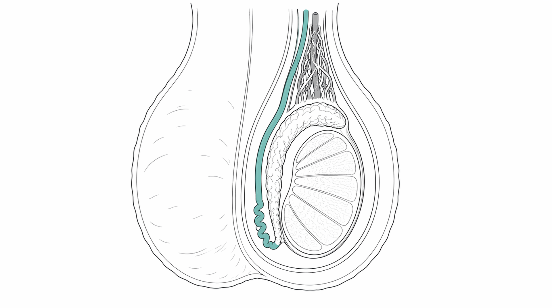 Medical line illustration of scrotal testicular anatomy for Vasectomy.