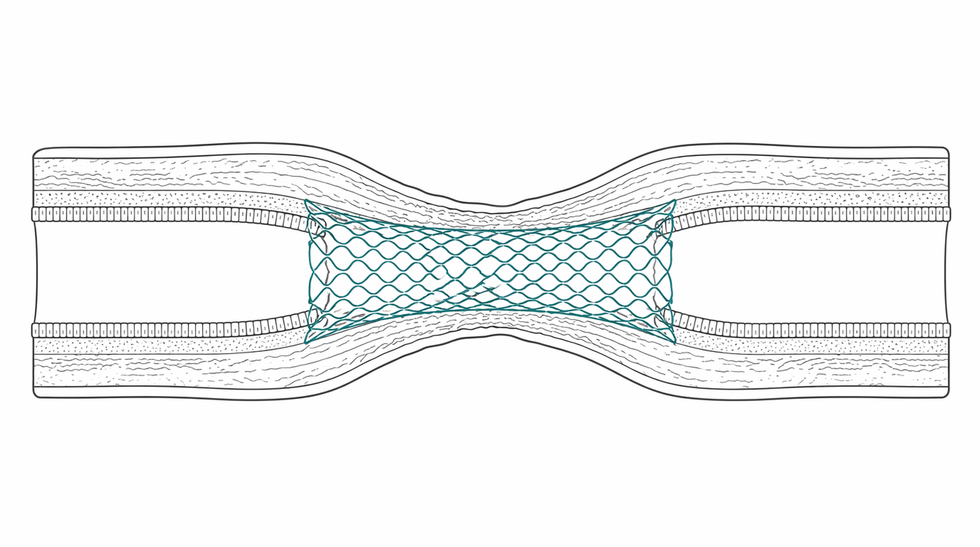 Medical line illustration of self expanding luminal stent for Oesophageal stent insertion.