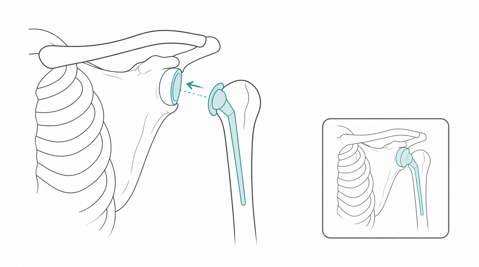 Medical line illustration of shoulder replacement for Shoulder replacement.