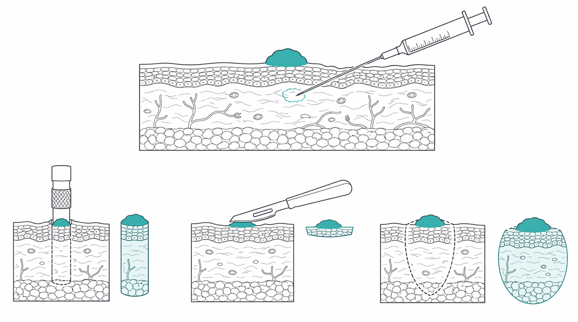 Medical line illustration of skin biopsy techniques for Mole or skin lesion removal.