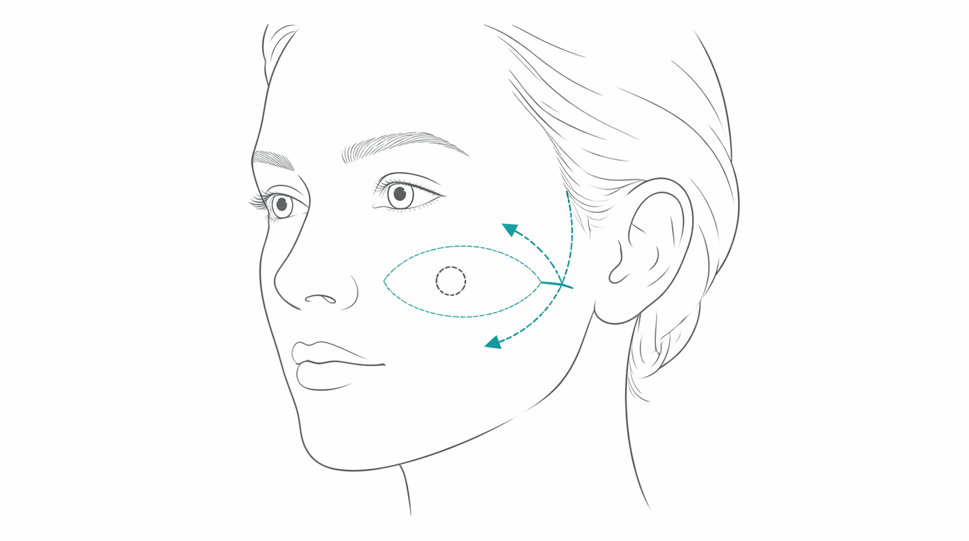 Medical line illustration of skin cancer excision reconstruction for Squamous cell carcinoma treatment.
