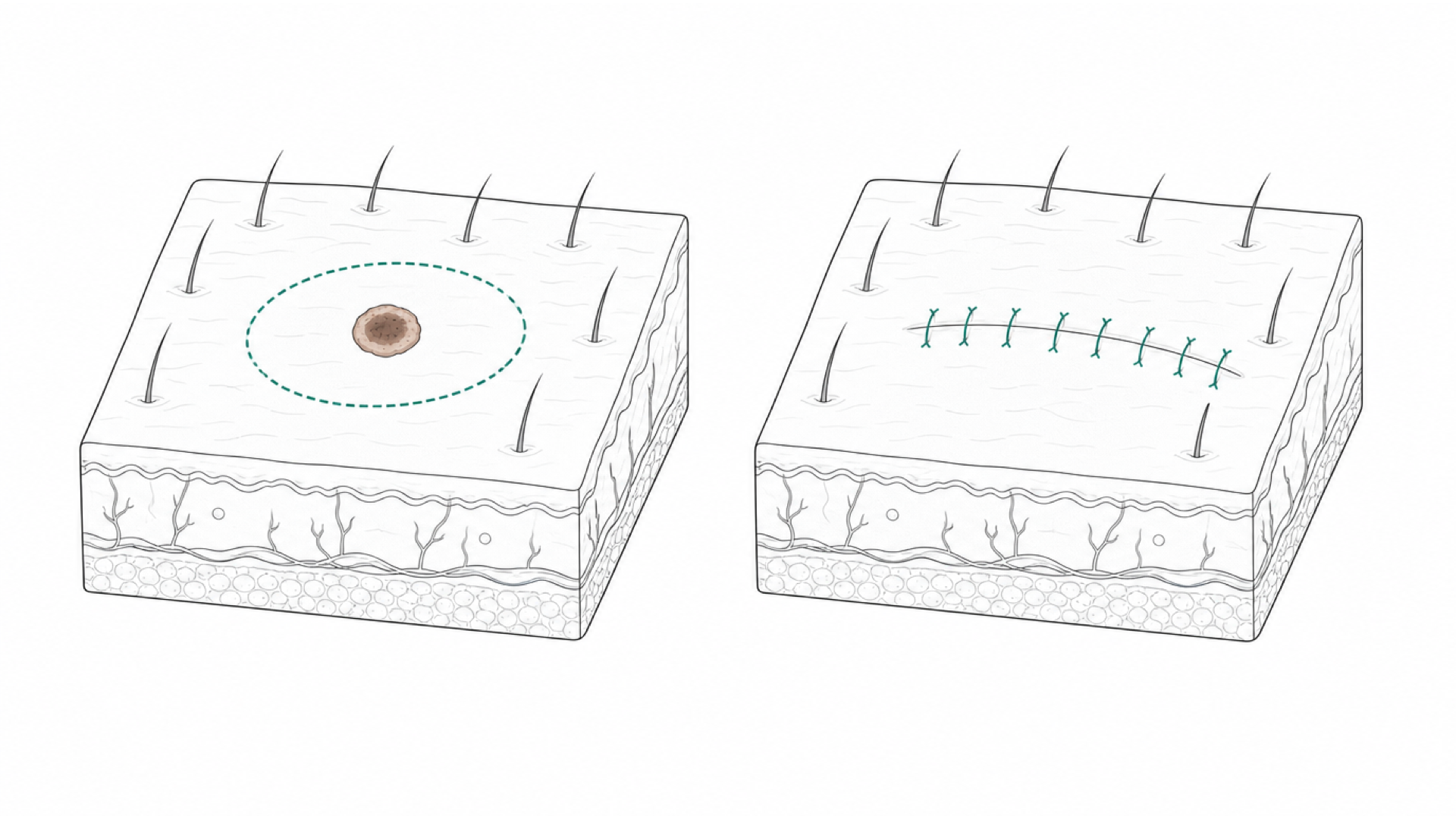 Medical line illustration of skin excision and sutured closure for Foreign body removal.