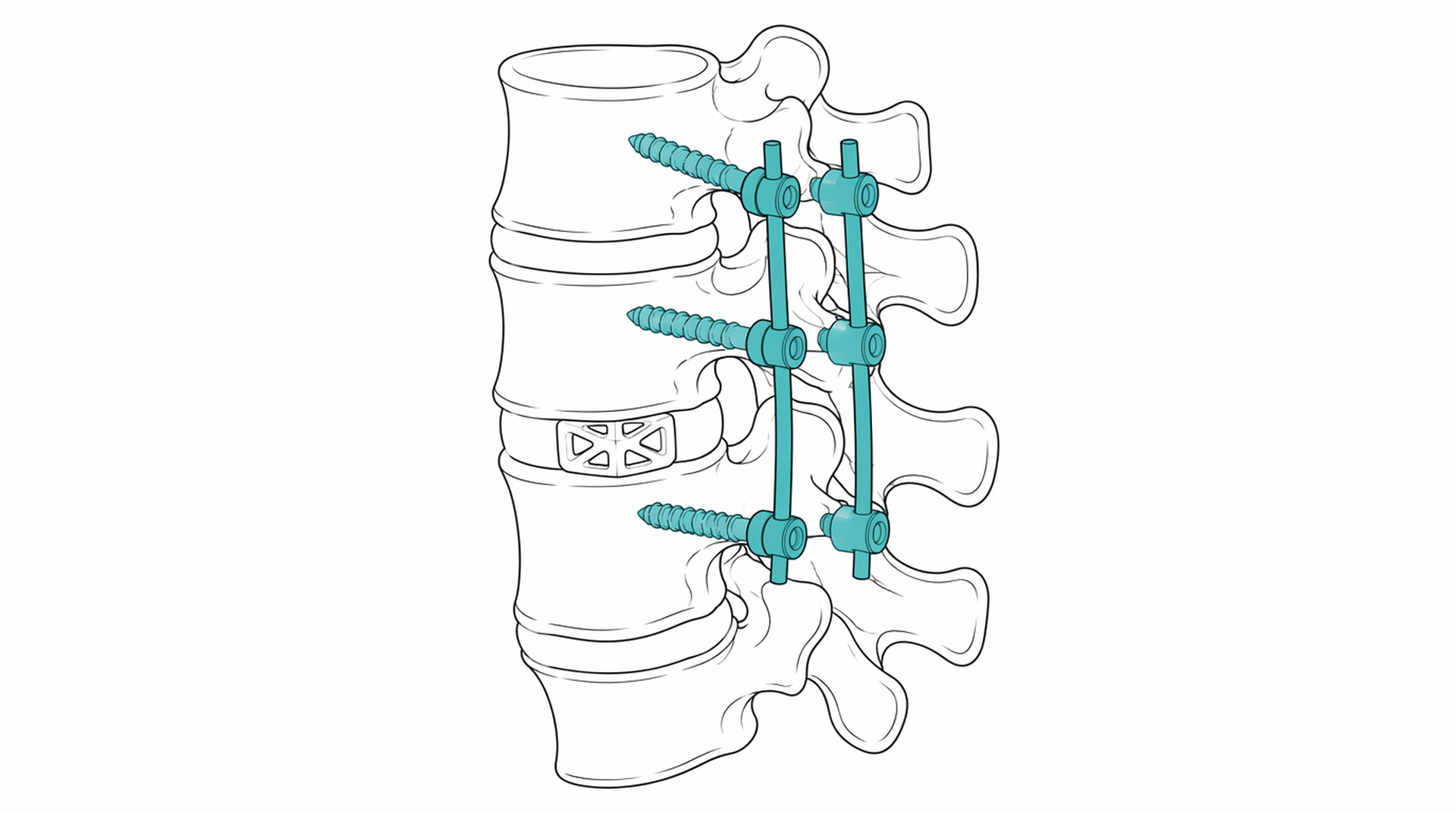 Medical line illustration of spinal fusion pedicle screws for Spinal fusion.