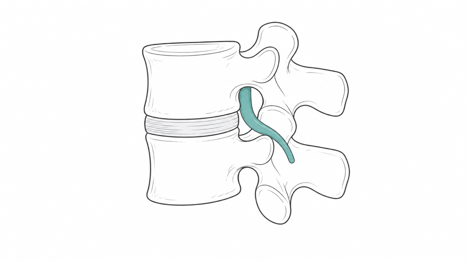 Medical line illustration of the spine and nerve root for Sciatica management.