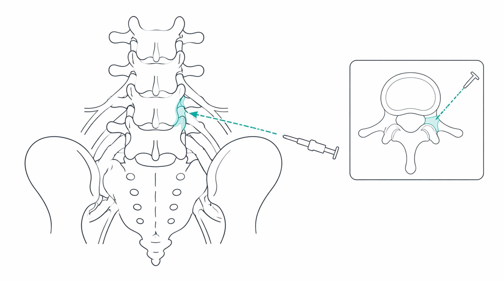 Medical line illustration of spine pain injection for Facet joint injection.
