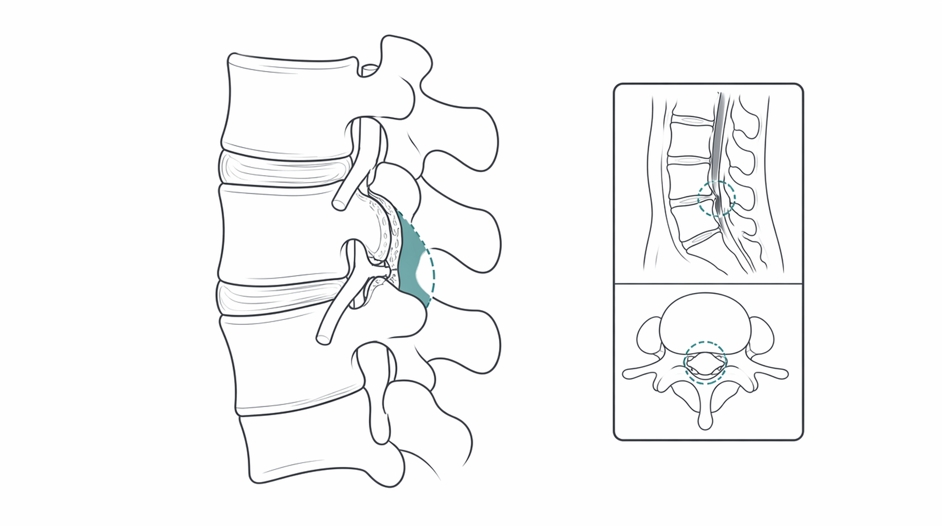 Medical line illustration of spine surgery disc decompression for Microdiscectomy.