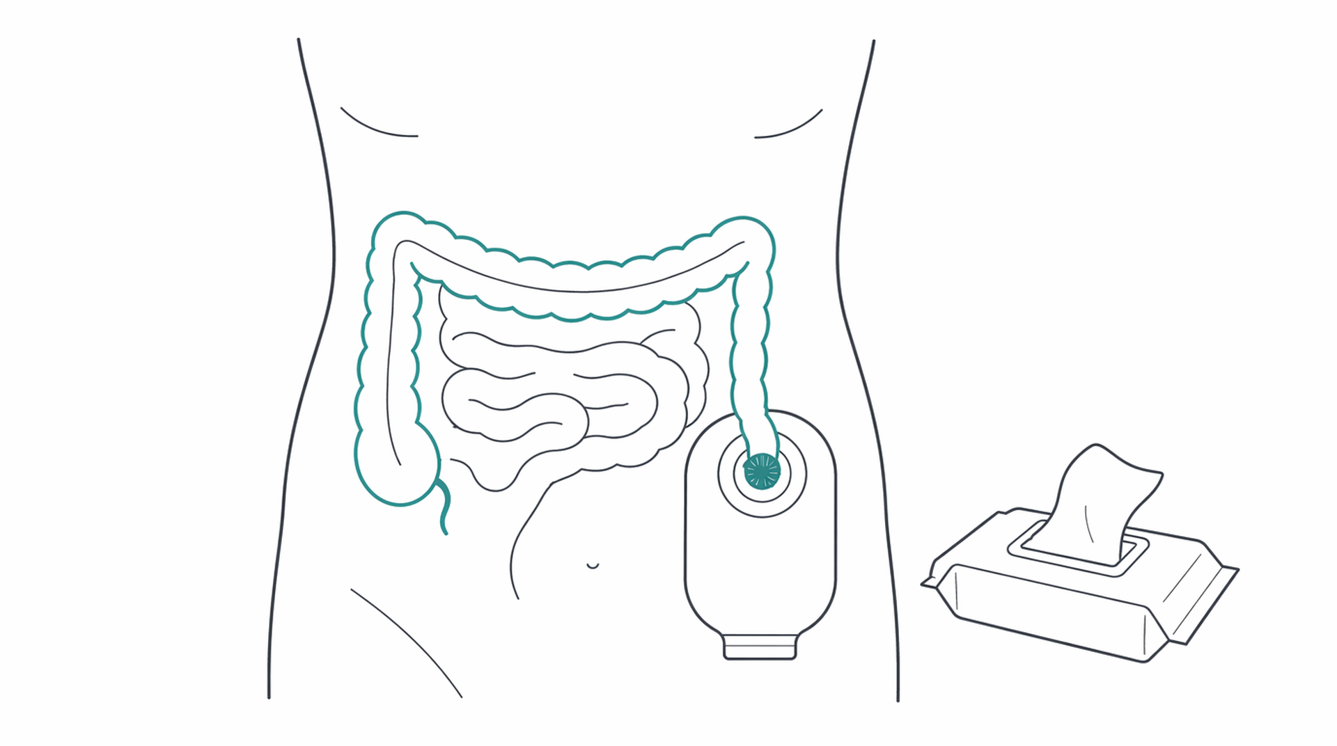 Medical line illustration of stoma care ileostomy colostomy for Ileostomy formation.