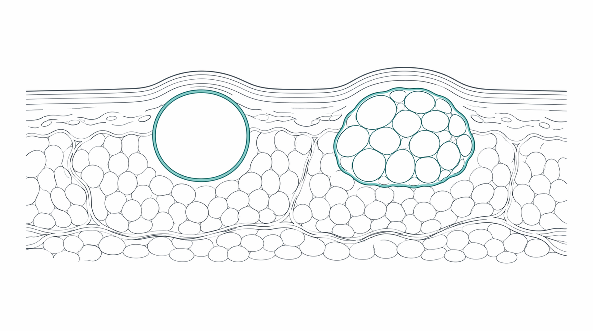 Medical line illustration of subcutaneous cyst and lipoma for Minor surgery (cyst, lipoma or mole removal).