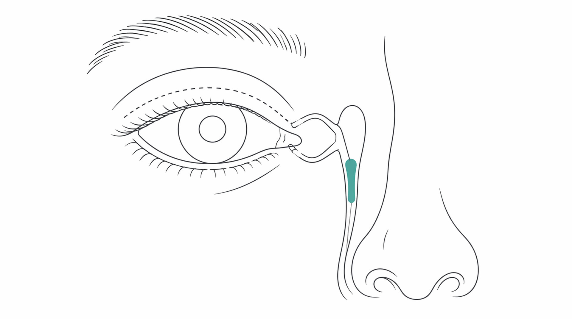 Medical line illustration of tear duct surgery for Tear duct surgery (DCR).