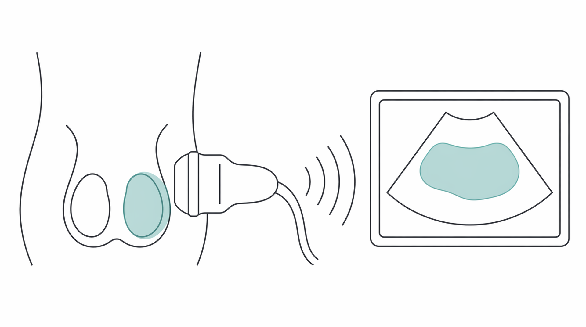 Medical line illustration of testicular scrotal ultrasound for Testicular (scrotal) ultrasound.