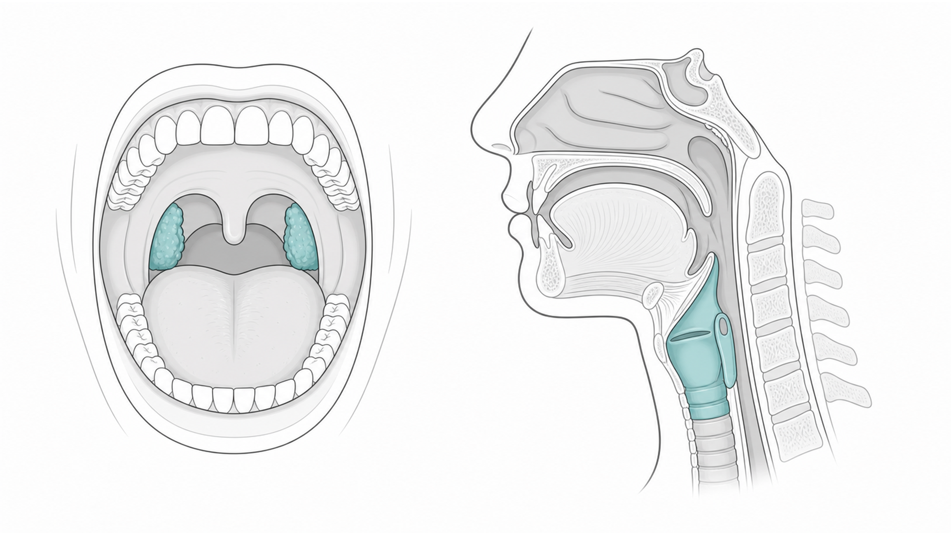 Medical line illustration of throat, tonsil and larynx anatomy for Tonsil removal (tonsillectomy).