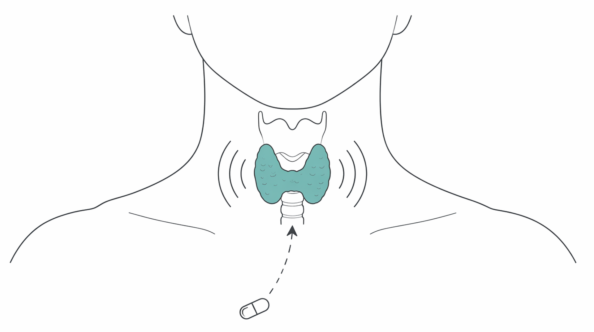 Medical line illustration of thyroid radioiodine treatment for Overactive thyroid (hyperthyroidism) management.