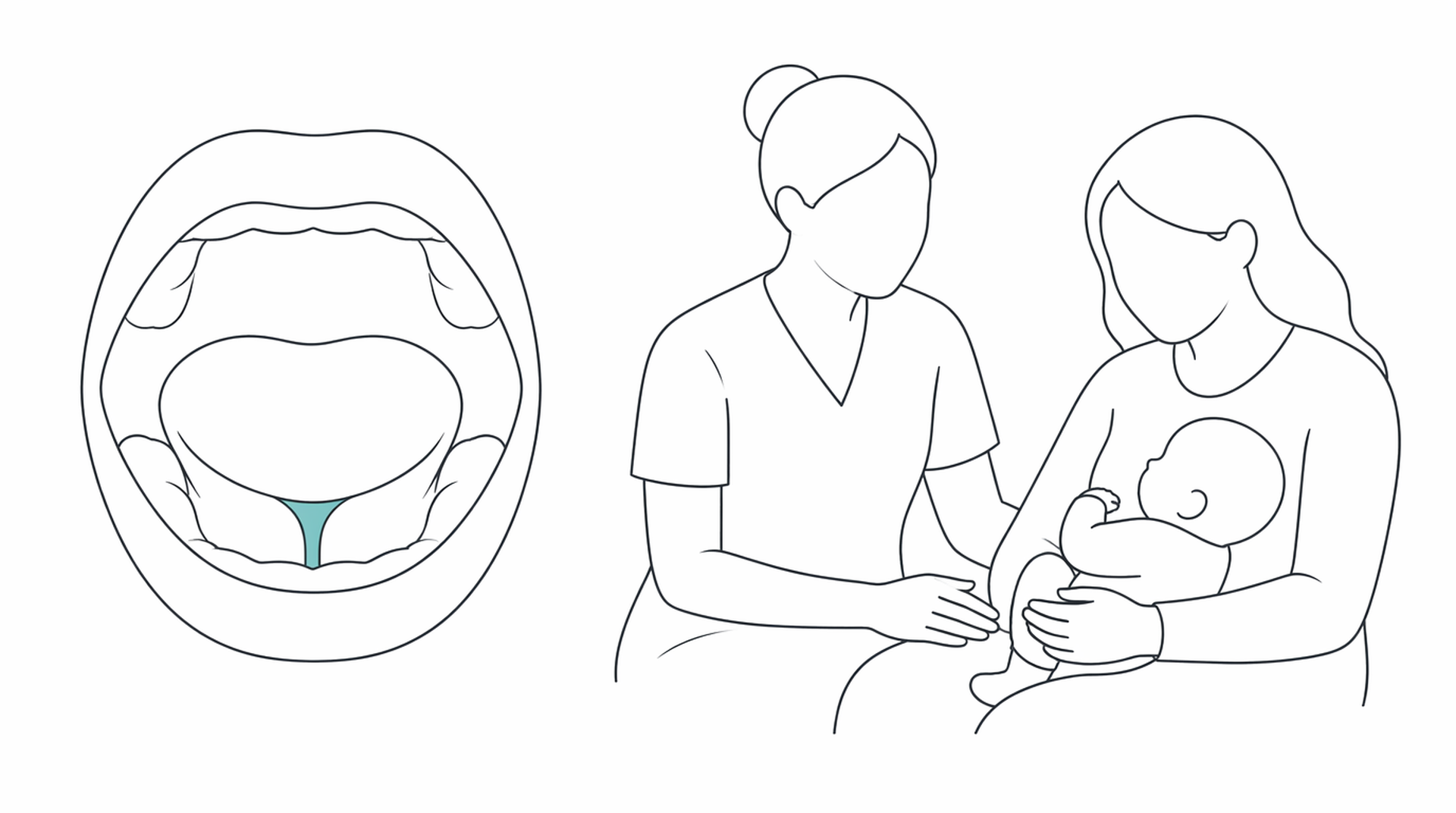 Medical line illustration of tongue tie baby feeding for Tongue-tie assessment and division in babies.