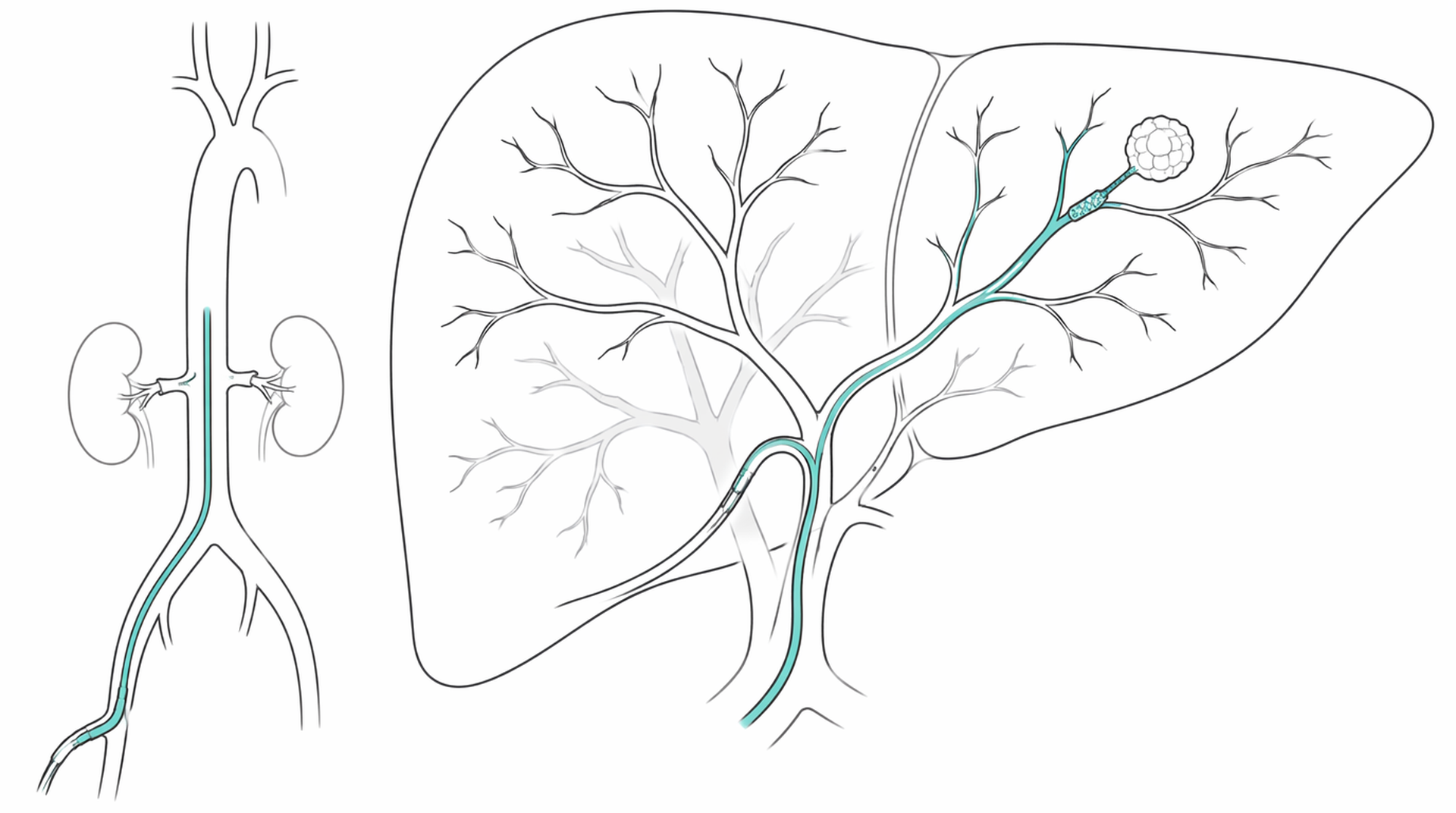 Medical line illustration of transarterial liver tumour treatment for TACE for liver tumours.