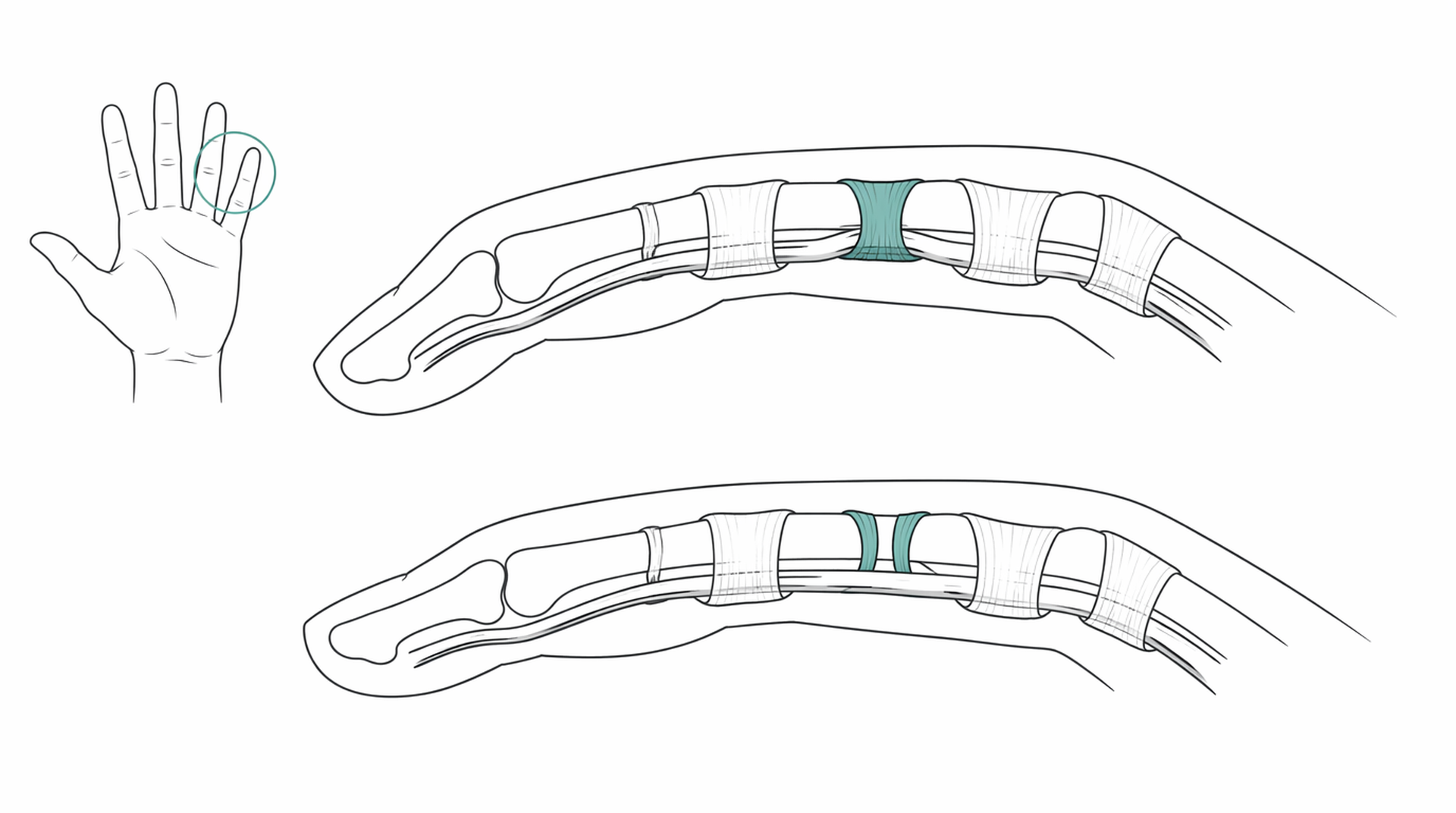 Medical line illustration of trigger finger release for Trigger finger release.