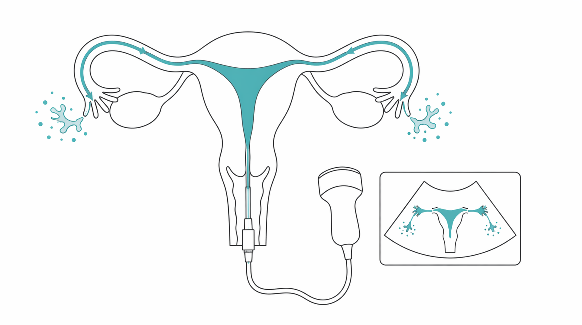 Medical line illustration of tubal patency test for Tubal patency test (HyCoSy / HSG).