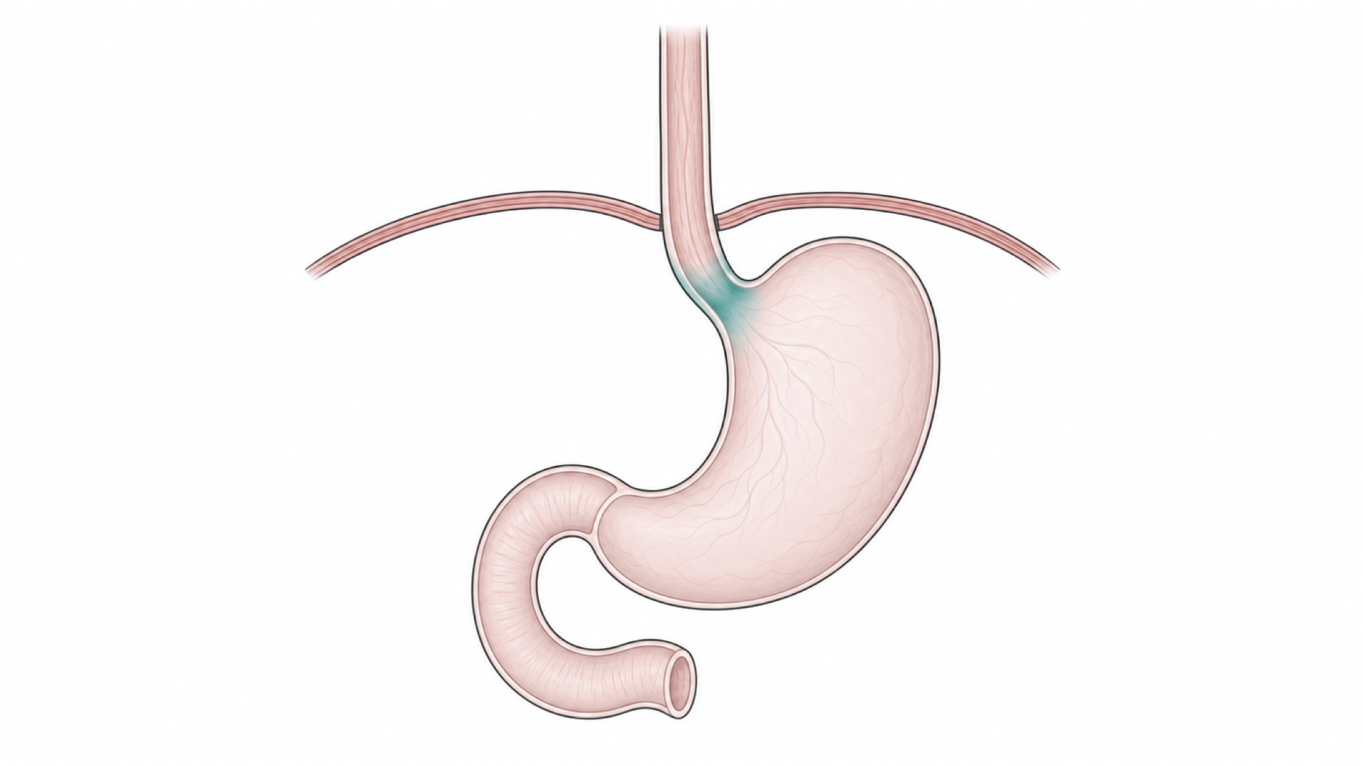Medical line illustration of the oesophagus and stomach for Stomach removal (gastrectomy).