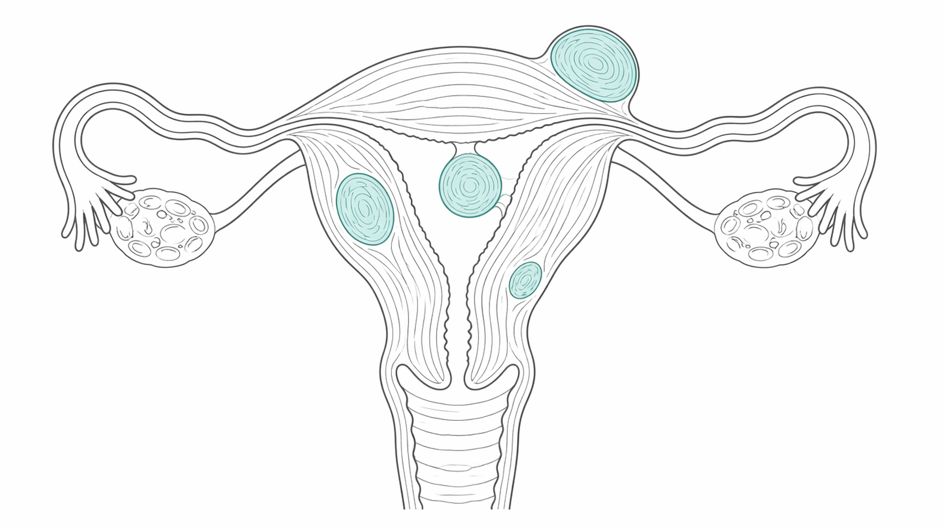 Medical line illustration of uterine fibroids for Hysterectomy (womb removal).
