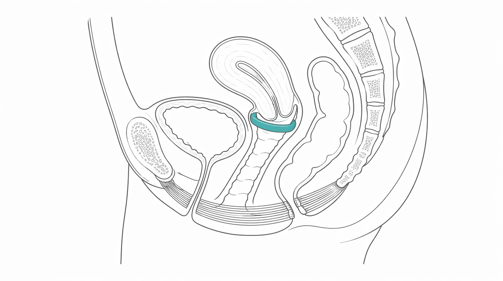 Medical line illustration of vaginal pessary for Vaginal prolapse repair.
