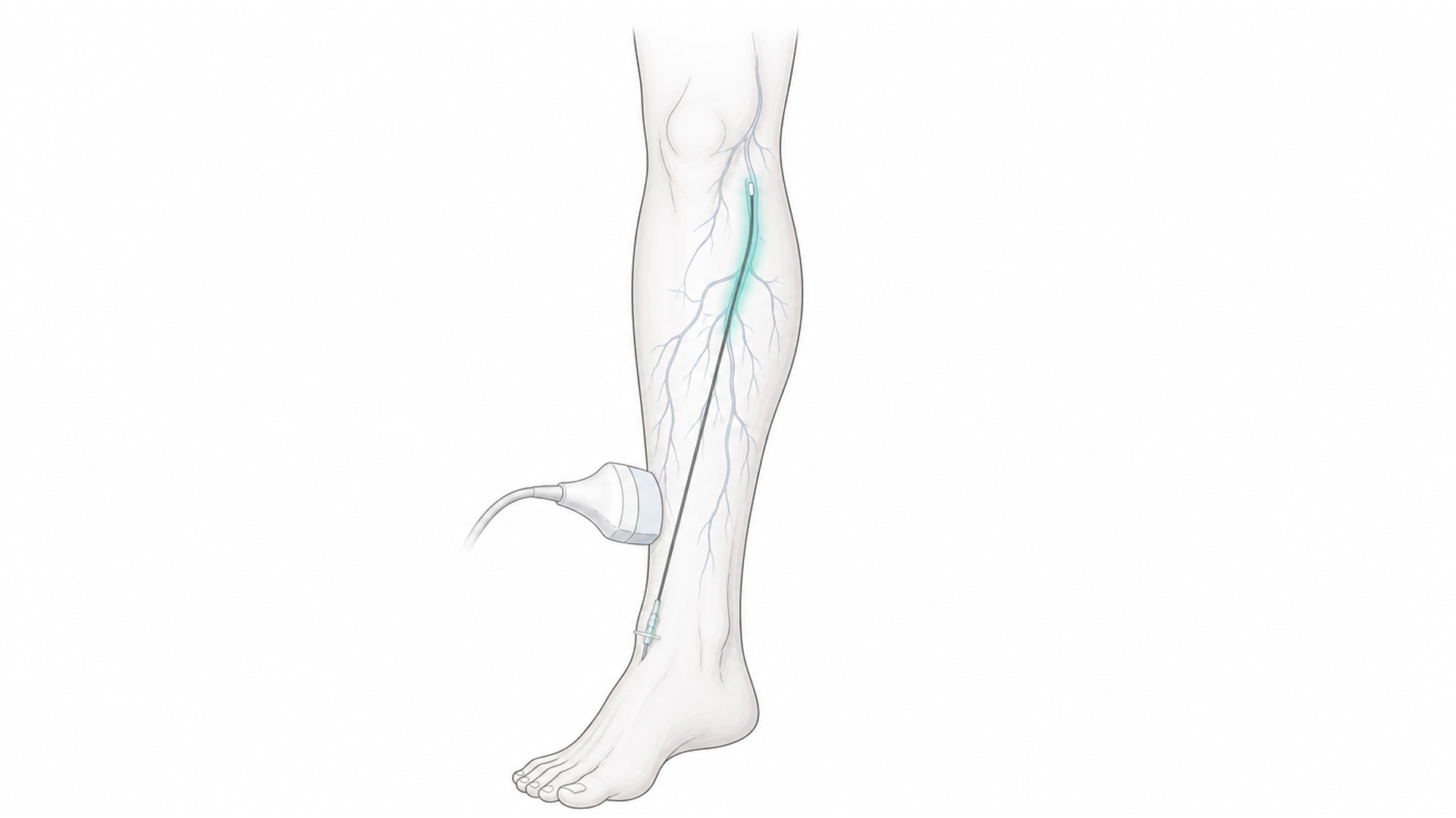 Medical line illustration of lower-leg vein assessment and varicose vein treatment for Phlebectomy (vein removal).