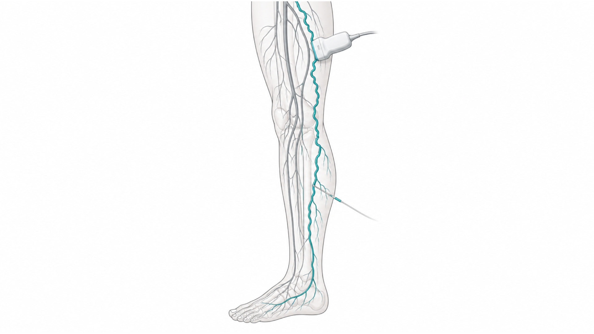 Medical line illustration of leg veins and vascular pathways for Hyperhidrosis (sympathectomy) surgery.