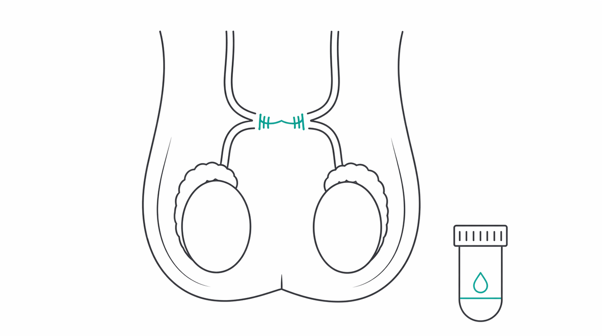 Medical line illustration of vasectomy reversal fertility for Vasectomy reversal.