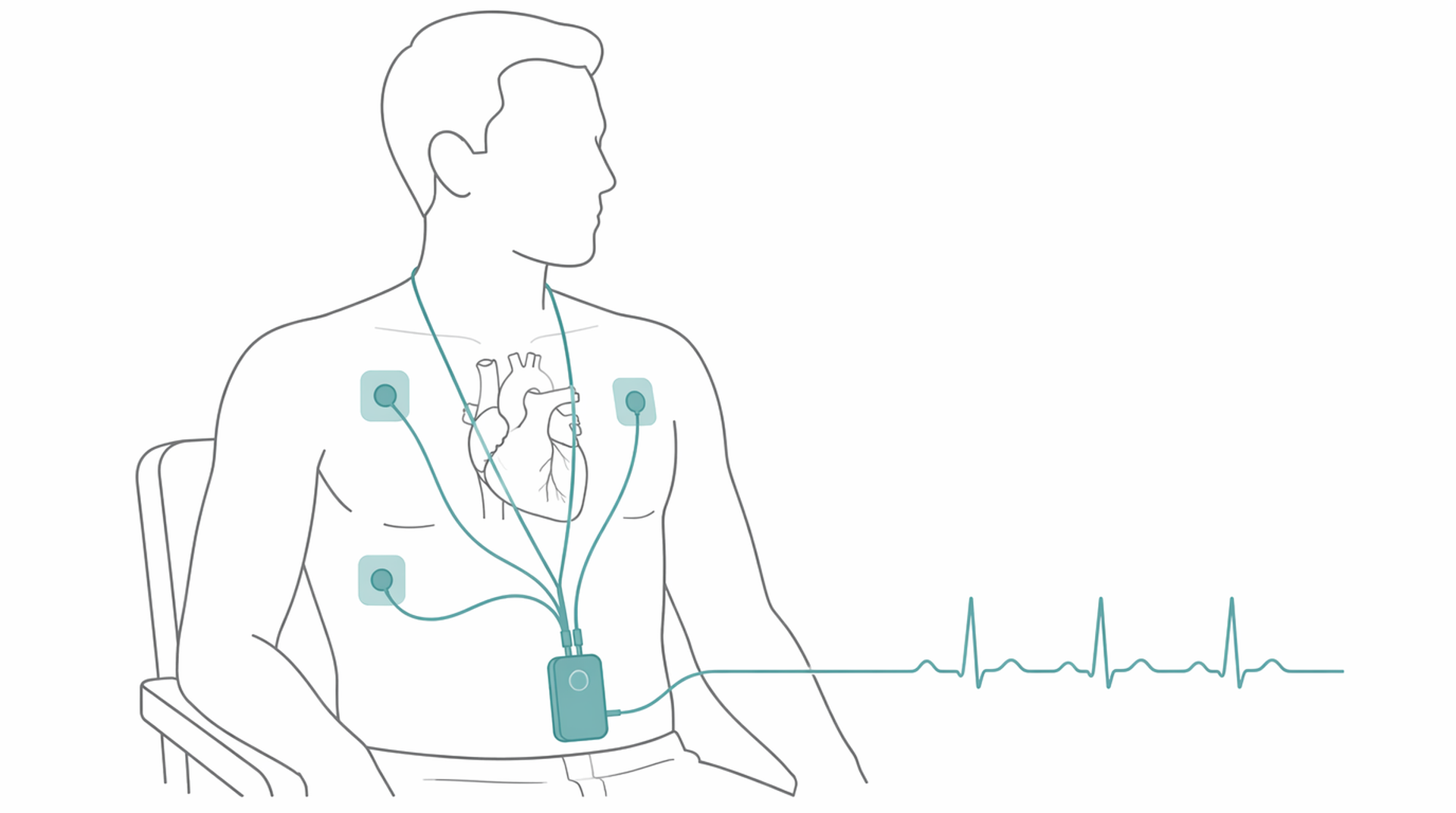 Medical line illustration of wearable heart rhythm monitor for Cardiac ablation.
