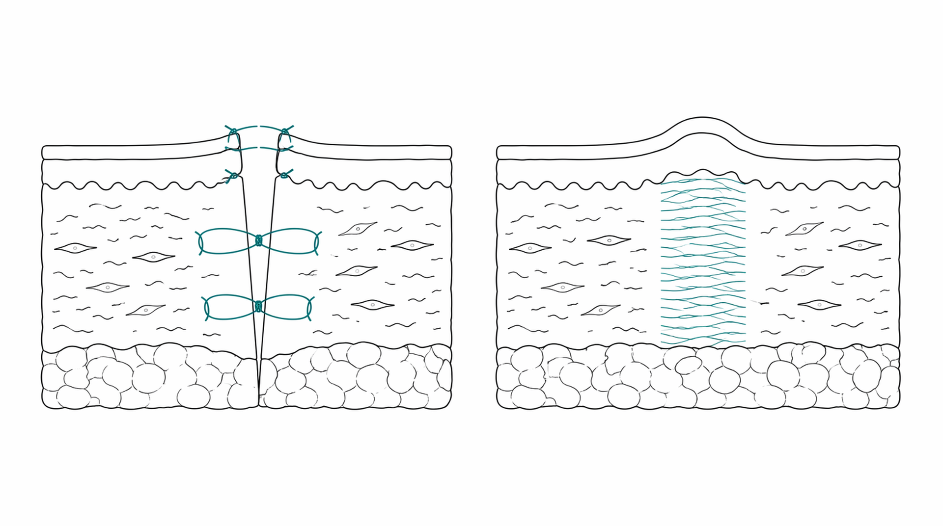 Medical line illustration of wound closure and scar cross section for Cuts and wound closure (stitches / glue).